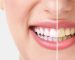 xdis-beyazlatma-1.jpg.pagespeed.ic.rW3nMRjyhI